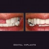 Dental_Implants